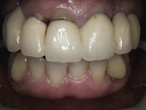 veneers-set2-A