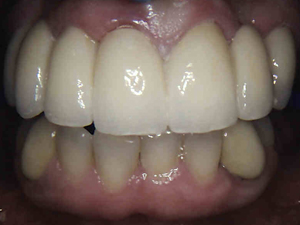 veneers-set2-B