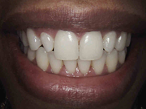 veneers-set3-A