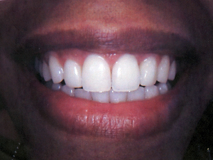 veneers-set3-B