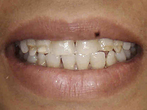 veneers-set4-A