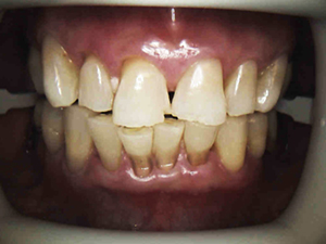 veneers-set5-A-300x325